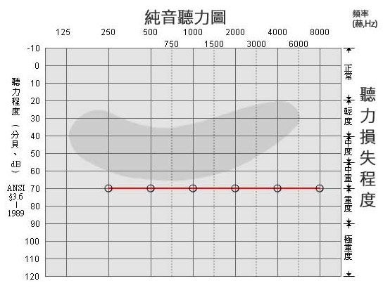 三分钟教您看懂听力测试结果听力图