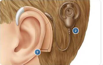 人工耳蜗刚开机要不要戴助听器？ 怎样尽快适应？