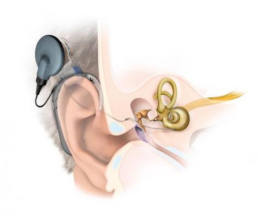 电子耳蜗的两项局限性