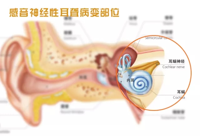 感音神经性耳聋能治好吗？