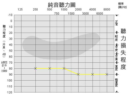 三分钟教您看懂听力测试结果-听力图(图3)