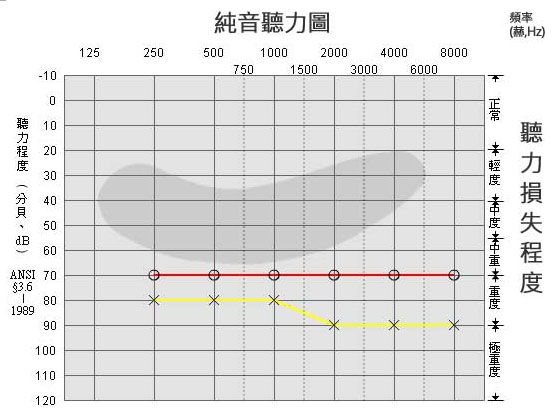 三分钟教您看懂听力测试结果-听力图(图4)