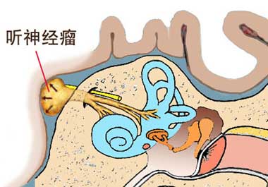 耳朵听不清问题可能在脑子—警惕听神经瘤